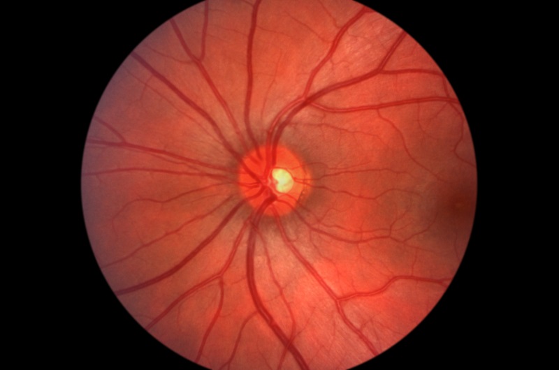 Glaucoma